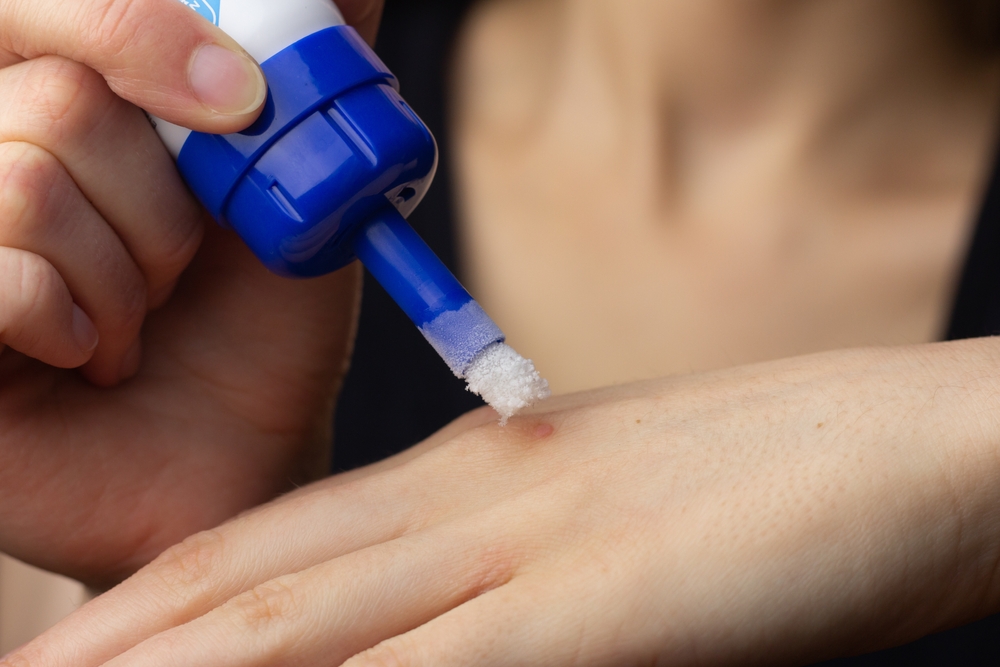 A woman is freezing a wart on her hand without a Montrose wart removal doctor.